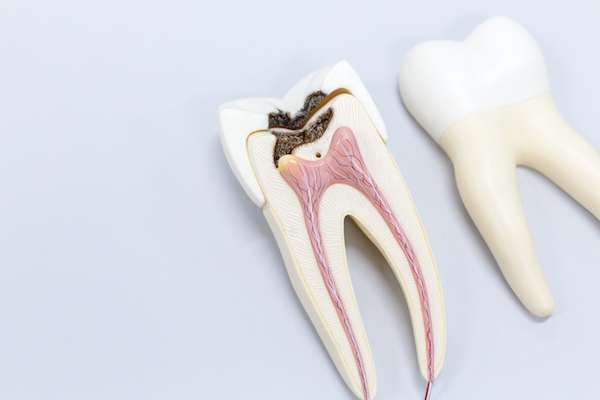 Ask a General Dentist: Is a Tooth Dead After a Root Canal from My Saratoga Dentist PLLC in Saratoga Springs, NY