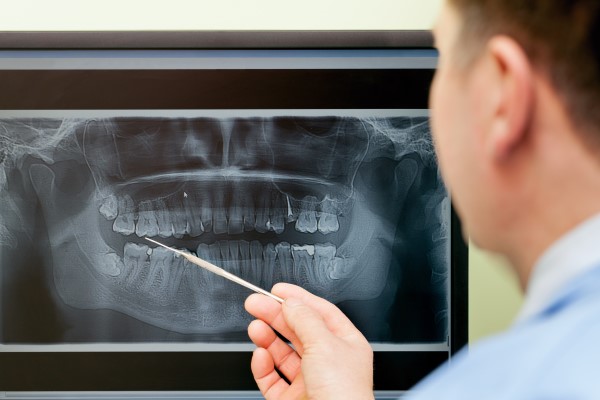 The FAQs Of Bone Graft Aftercare