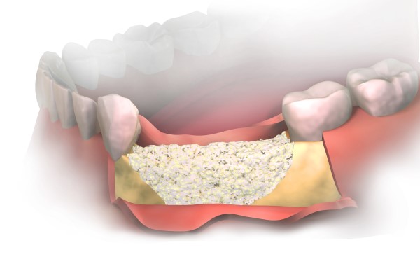 Bone Grafting For Dental Implant Placement