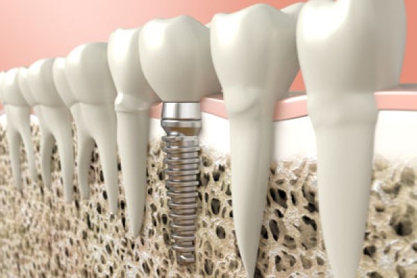 Bone Graft For Dental Implants: Why It Matters And How Healing Works