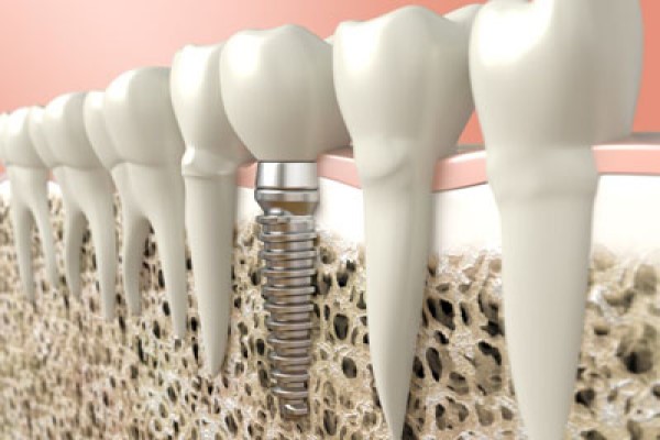 Bone Grafting For Dental Implant Placement