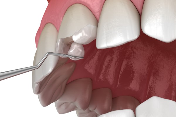 Reasons To Address A Chipped Tooth Immediately