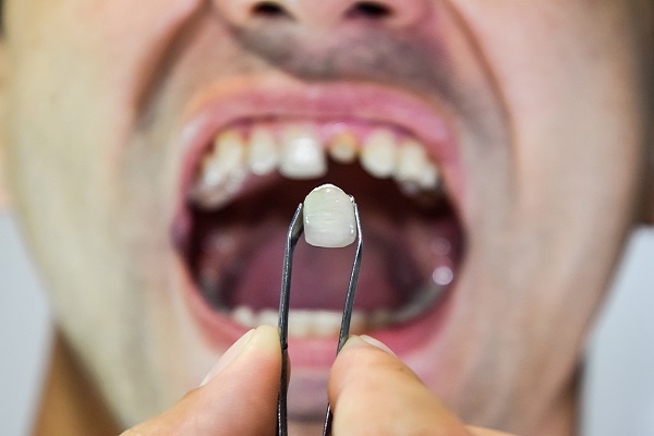 What Can Happen After A Chipped Tooth: Decay And  Sensitivity