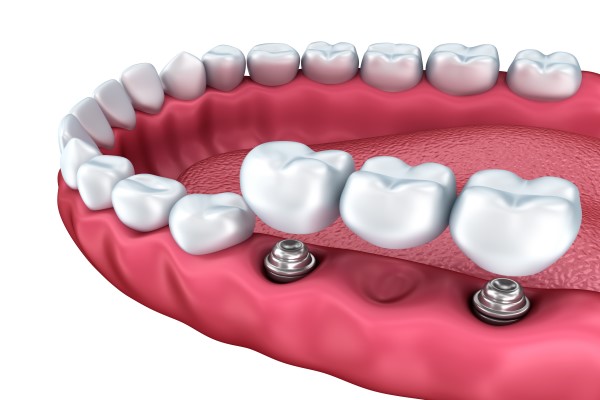 Multiple Tooth Implant: How Many Implants Are Needed To Support A Dental Bridge?