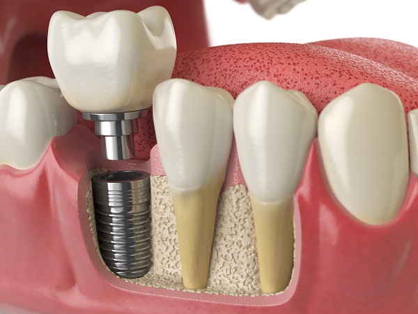 Dental Implant Restoration Saratoga Springs, NY
