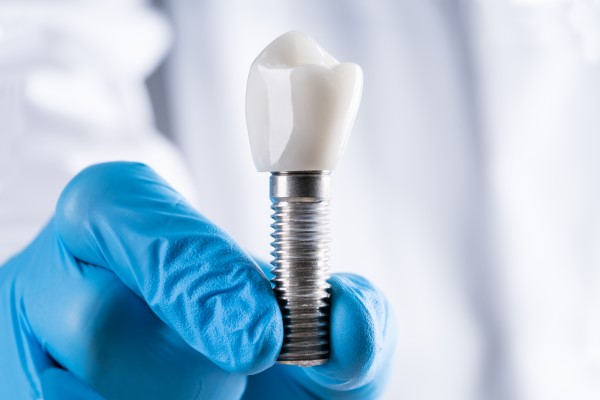 Can Dental Implants Replace Front Teeth?