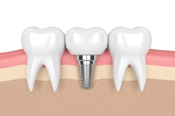Dental Implants Are A Solution For Missing Teeth