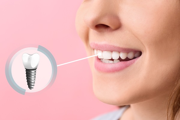 The Importance Of Implant Restoration