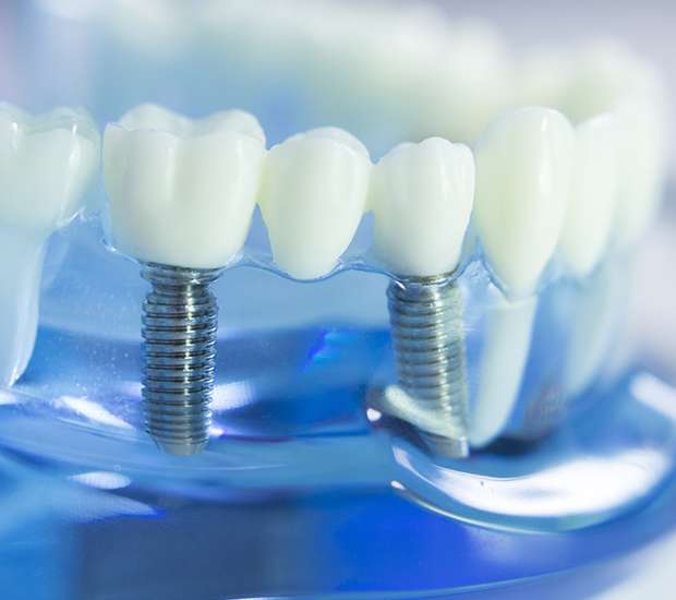 Saratoga Springs Dental Implants