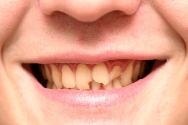 How A Broken Tooth Can Be Helped With Dental Restoration