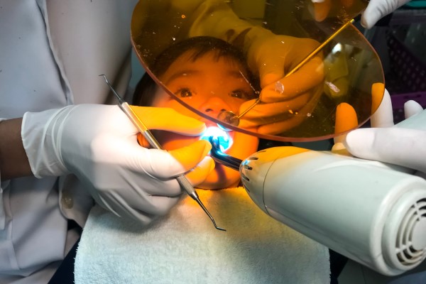 Are Dental Sealants Effective Against Tooth Decay?