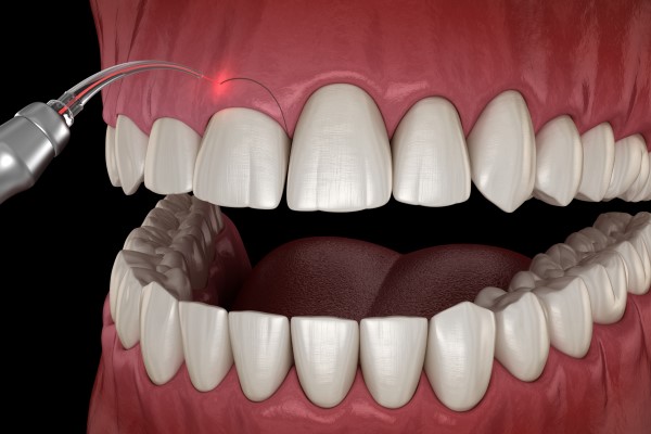 What Is Cosmetic Gum Surgery?