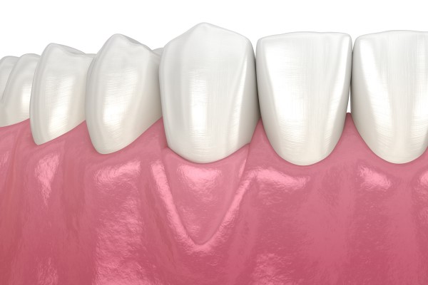 How Can A Dentist Tell If I&#    ;m A Candidate For Gum Grafting?