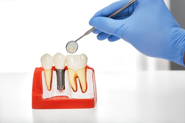 Implant Crowns: A Durable And Natural Looking Solution For Tooth Restoration