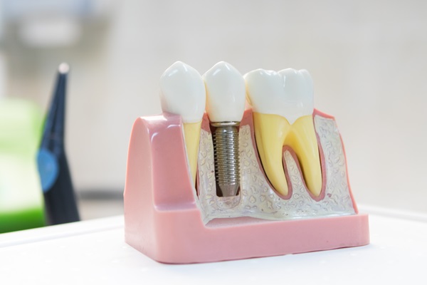 An Implant Dentist Discusses Bone Growth And Healing After Placement