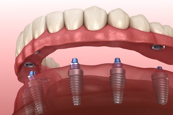 Benefits Of Implant Supported Dentures