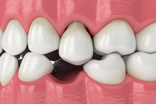 Tooth Replacement And Traditional Dentures