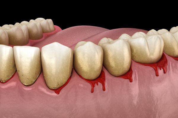 What Can Happen If You Miss Periodontal Checks And Care At A Dental Checkup