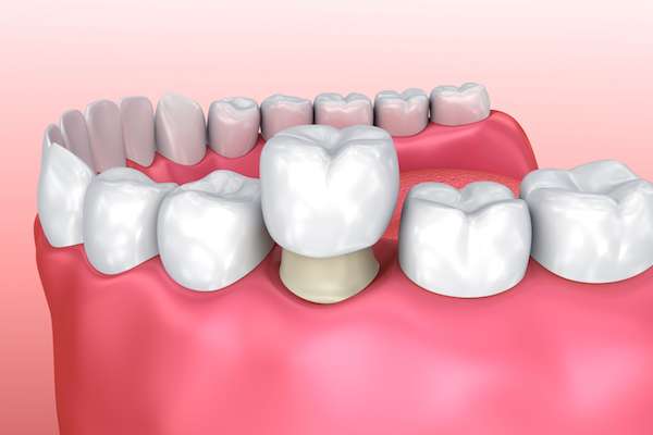 Permanent Dental Crowns vs. Temporary: Is There a Difference from My Saratoga Dentist PLLC in Saratoga Springs, NY