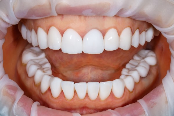 How A Smile Makeover Can Benefit Stained Teeth