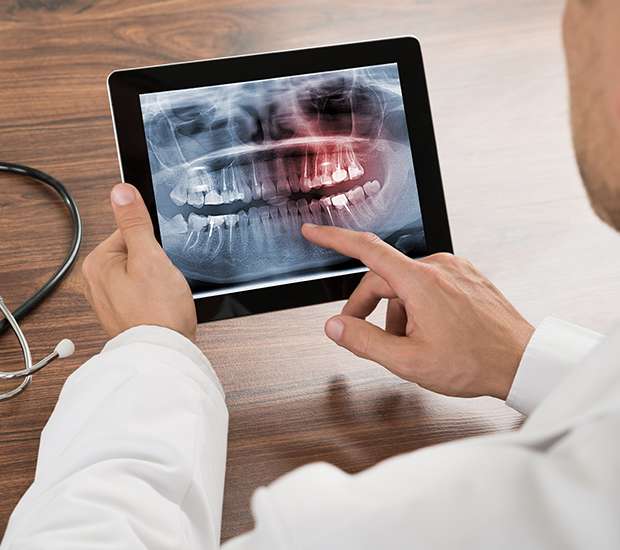 Saratoga Springs Types of Dental Root Fractures