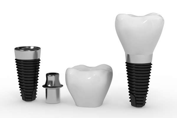 What Are The Parts Of Dental Implants
