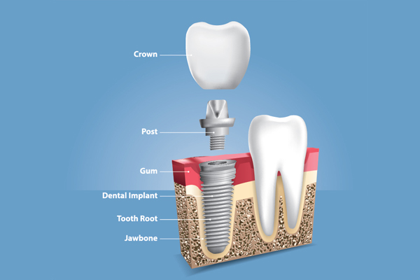 When A Crown Is Placed In The Implant Dentistry Procedure