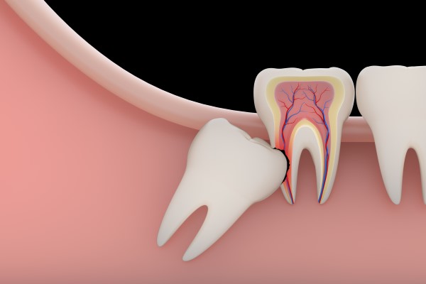 How Long Is Recovery From A Wisdom Tooth Extraction?