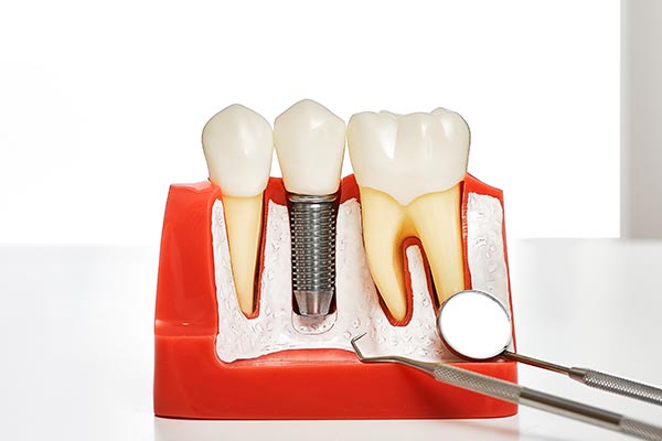 Your Guide to Different Kinds of Dental Implants from My Saratoga Dentist PLLC in Saratoga Springs, NY